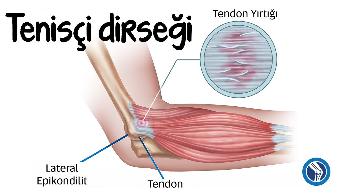 Lateral Epikondilit